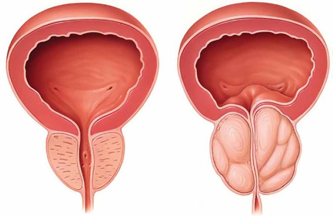 Простата в норме и воспаление предстательной железы (хронический простатит)