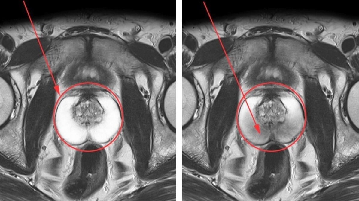 УЗИ при хроническом простатите – здоровая простата (слева) и воспаленная (справа)